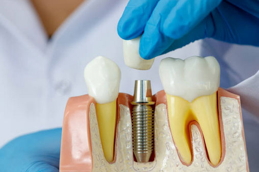 Dental Implant Restorations in Las Vegas, NV - Prime Care Dental 