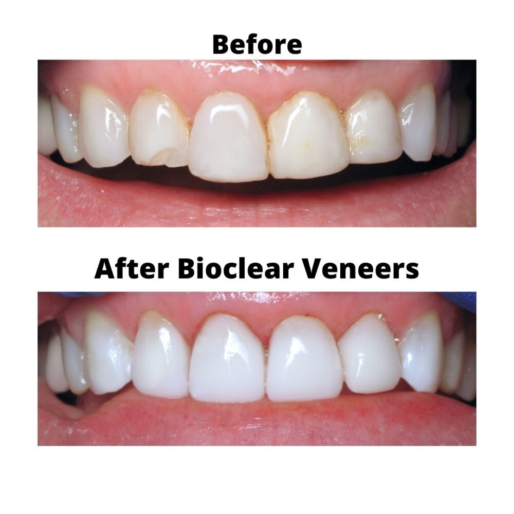 BIOCLEAR Certified Dentist in Las Vegas Bioclear Veneer Prime Care