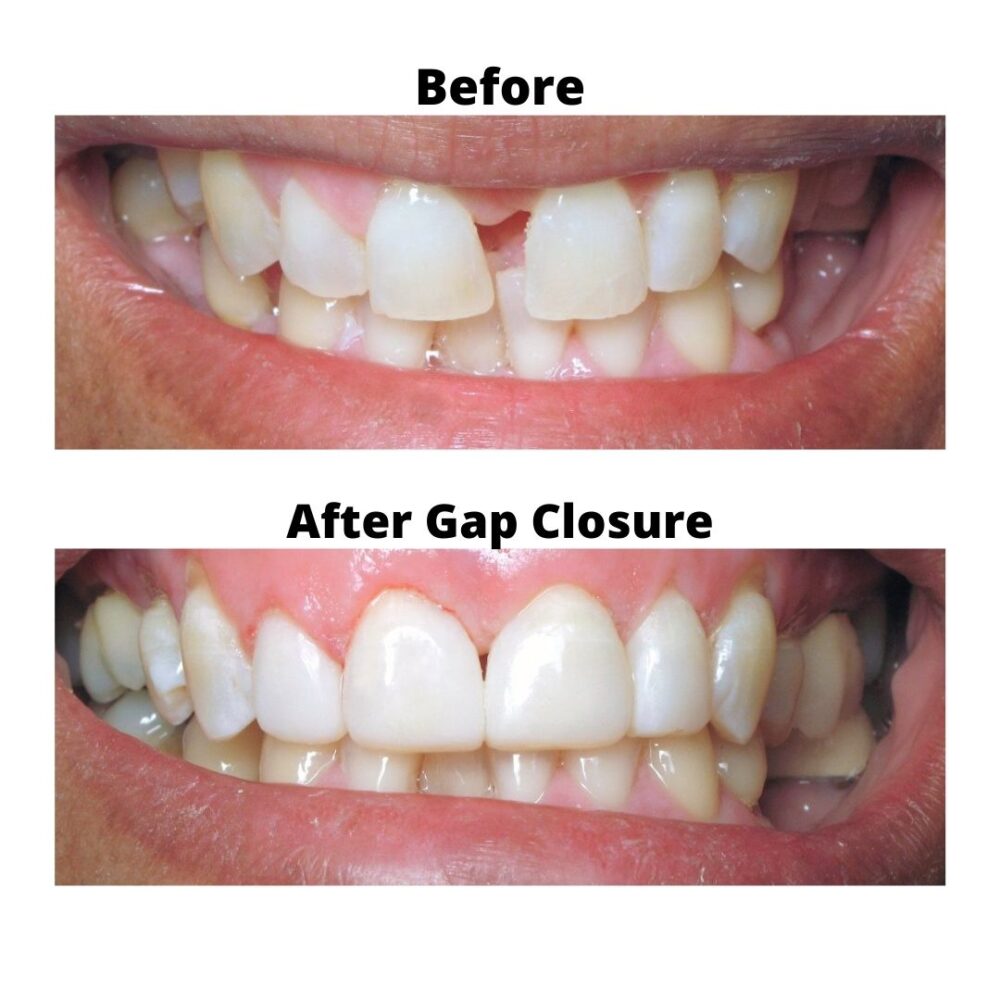 BIOCLEAR Certified Dentist in Las Vegas Bioclear Veneer Prime Care