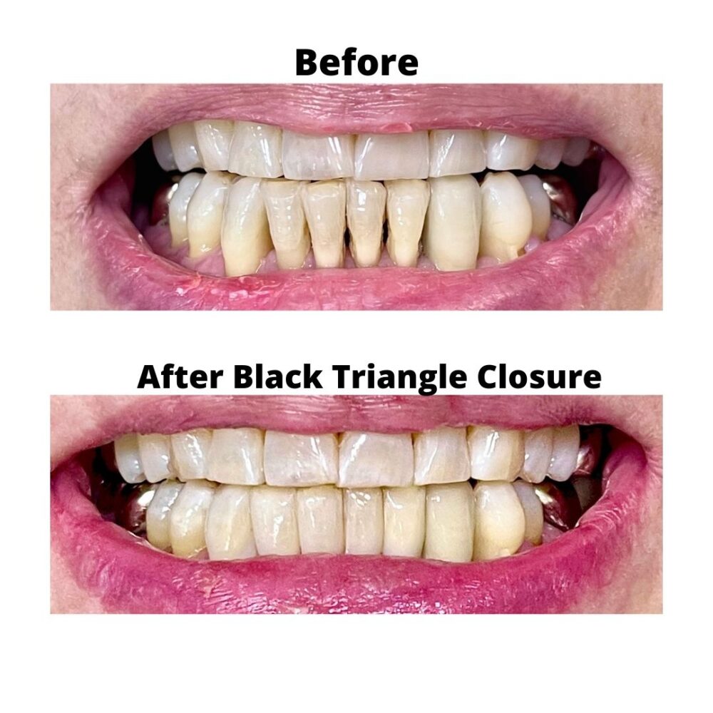 BIOCLEAR Certified Dentist in Las Vegas Bioclear Veneer Prime Care